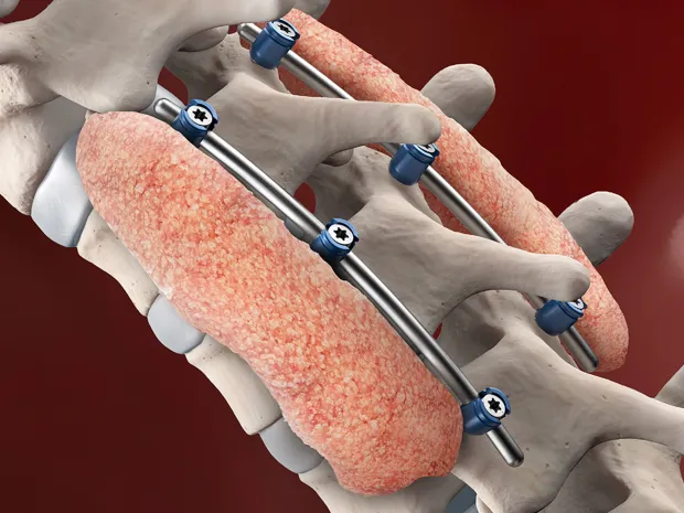 baxter_spine-20bone-20graft_0