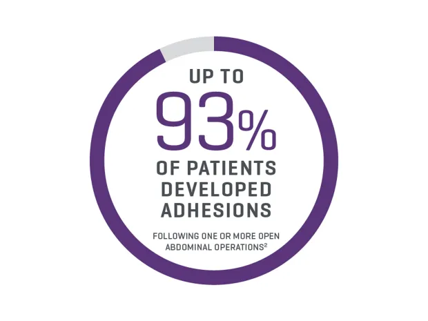Adhesions develop routinely following both open and laparoscopic abdominal surgery and have been reported at second-look surgery to occur in up to 93% of patients