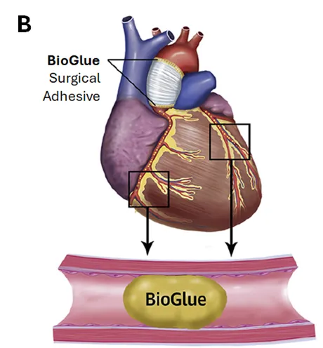 Illustration of coronary embolism in the mid-LAD and right coronary artery due to BioGlue Surgical Adhesive.