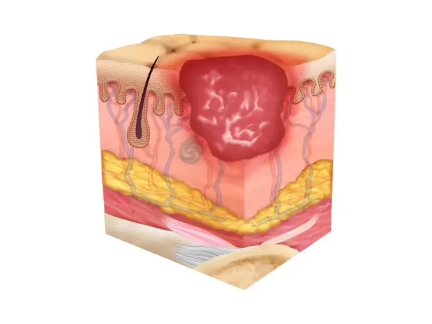 Ilustration of the skin surface with a Stage 2 pressure injury, with the wound close to the surface of the skin