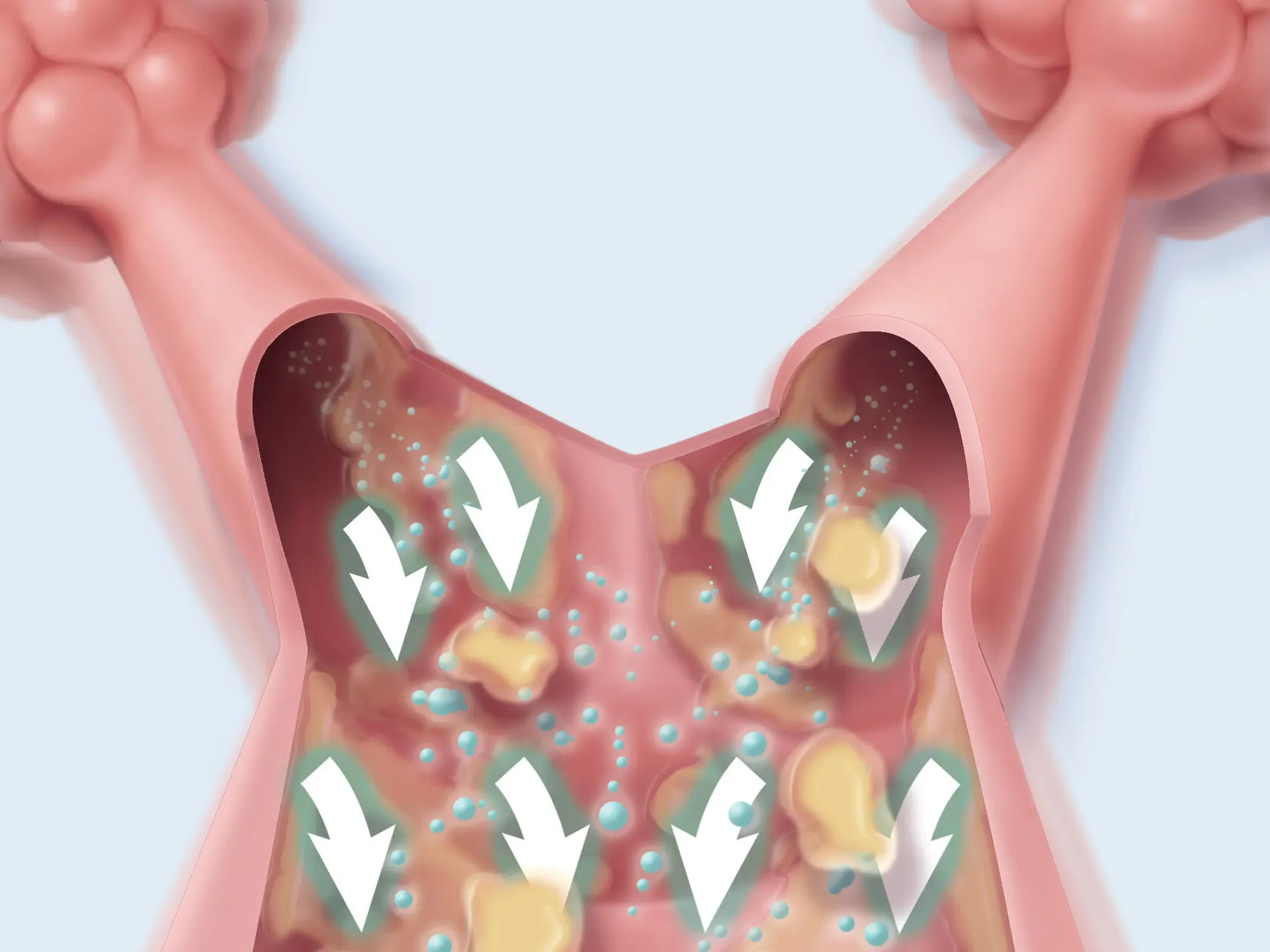 Lung mobilization CHFO image accelerated expiratory airflow