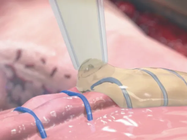 suture